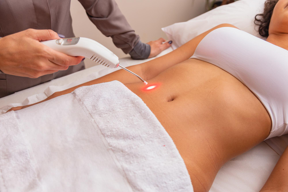 Therapy Skin Laser - Para as mamães que realizam parto de cesárea