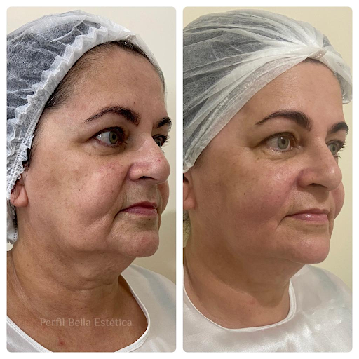 Tratamento para Flacidez Facial em Guarulhos