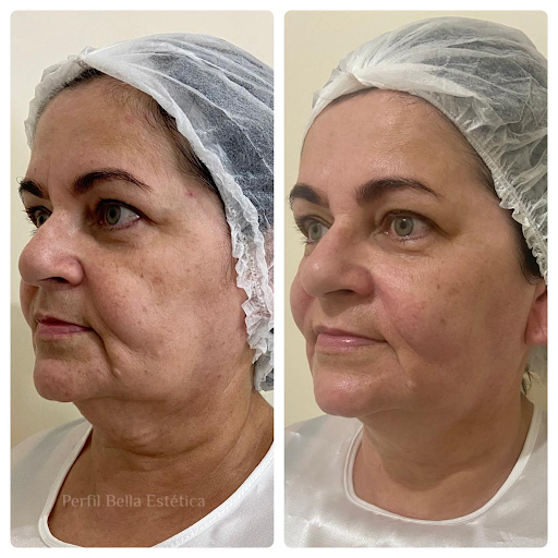 Tratamento para Flacidez Facial em Guarulhos